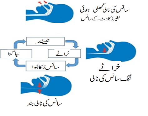 Sleep Apnea Process