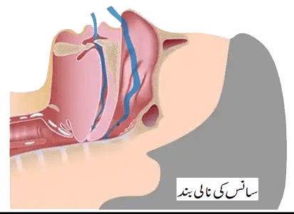 Obstructive Sleep Apnea